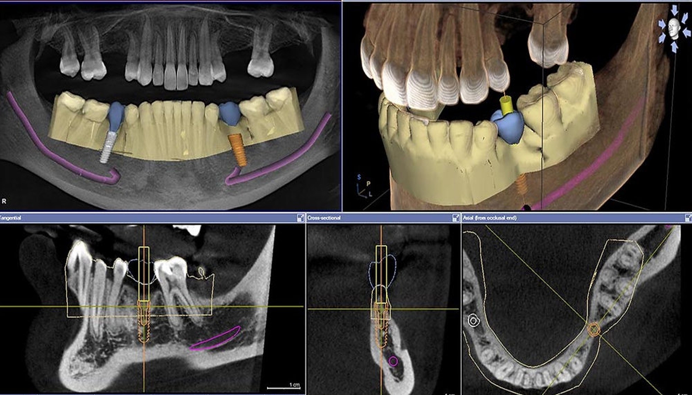 implantologia dentale